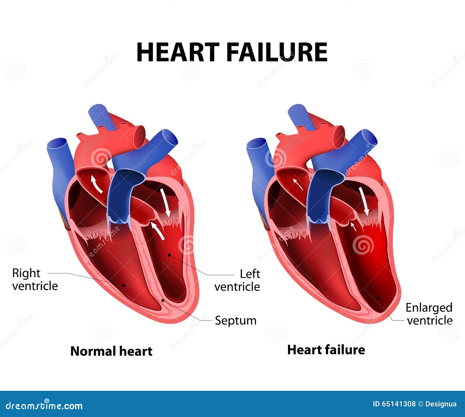 Heart failure stock vector. Illustration of dysfunction - 65141308