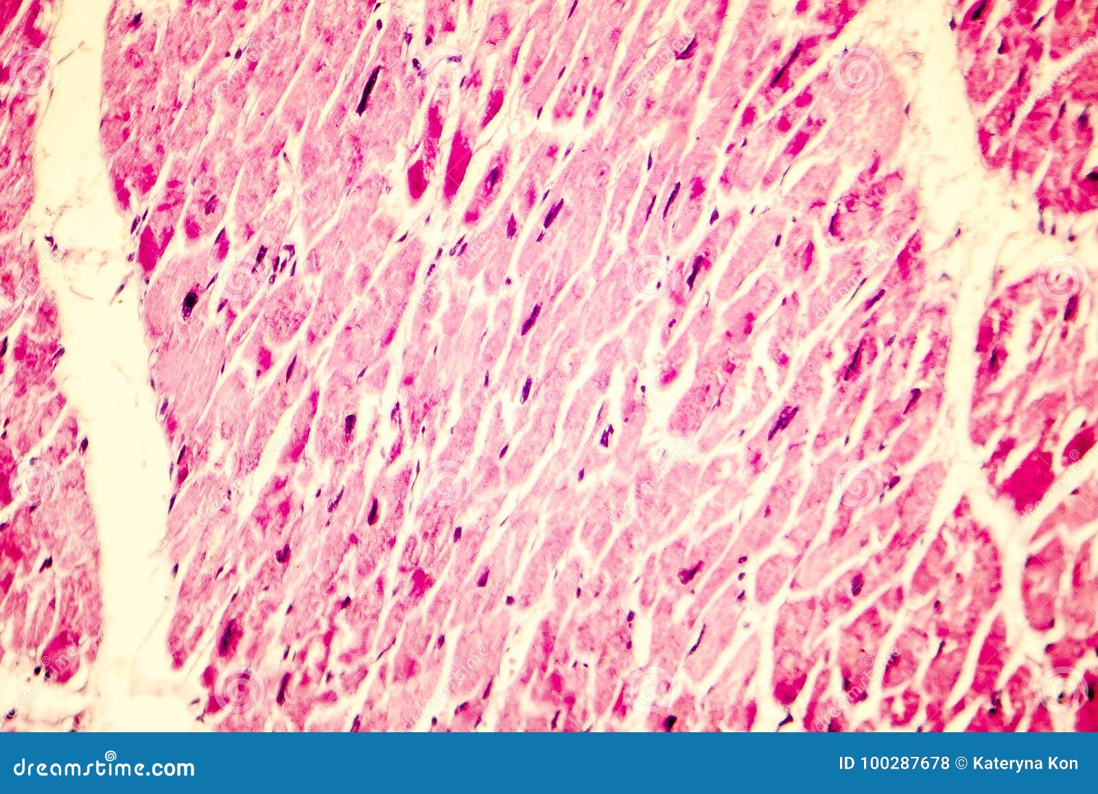 heart hypertrophy photomicrograph