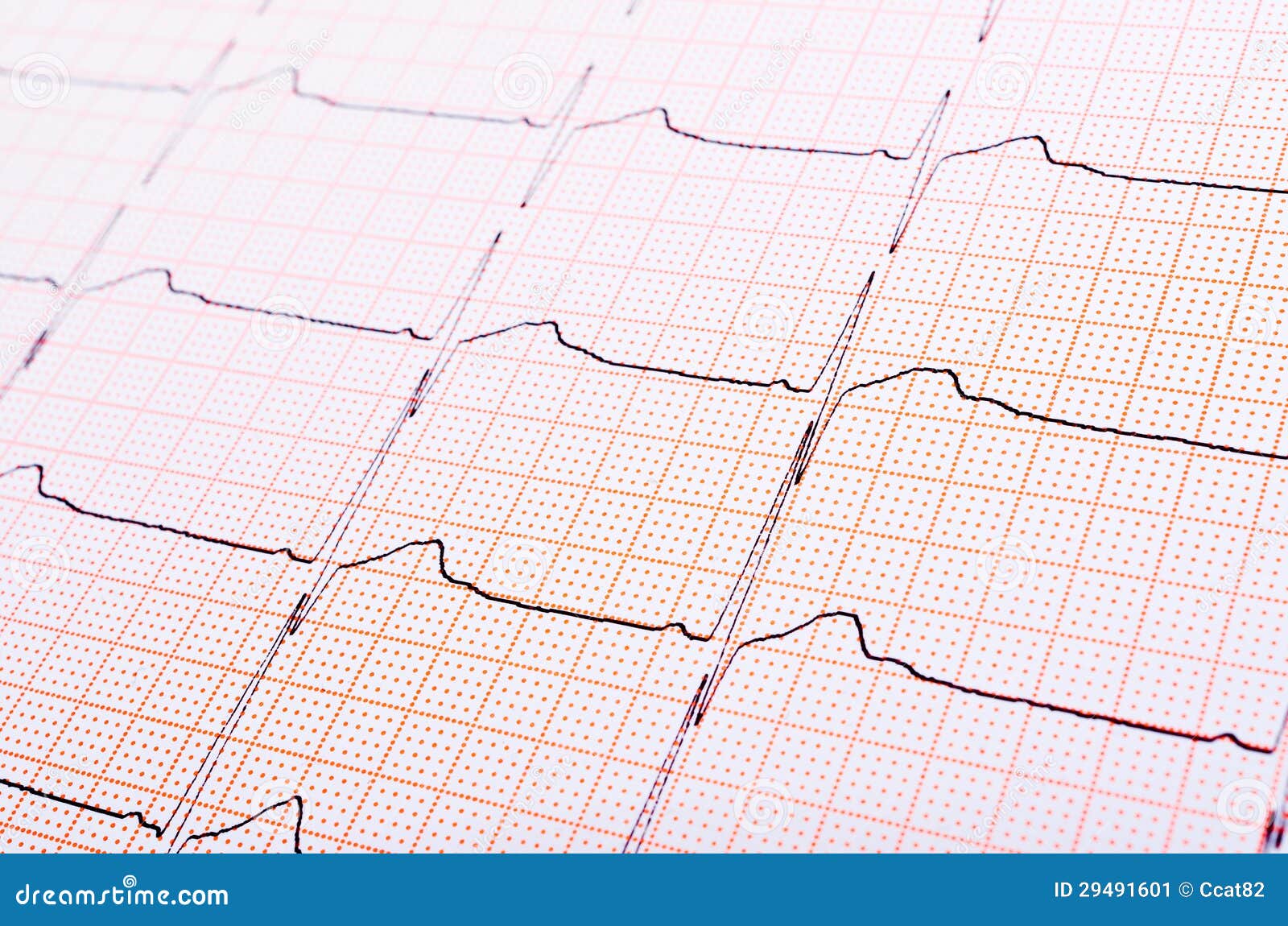 Heart Rhythm Chart