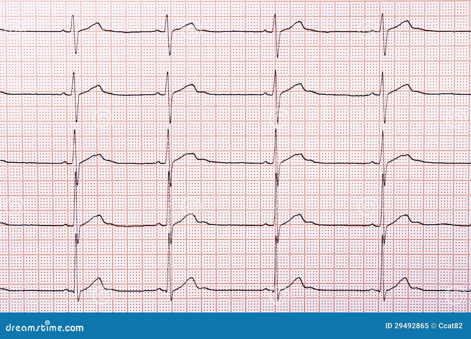 Sinus Rhythm Chart