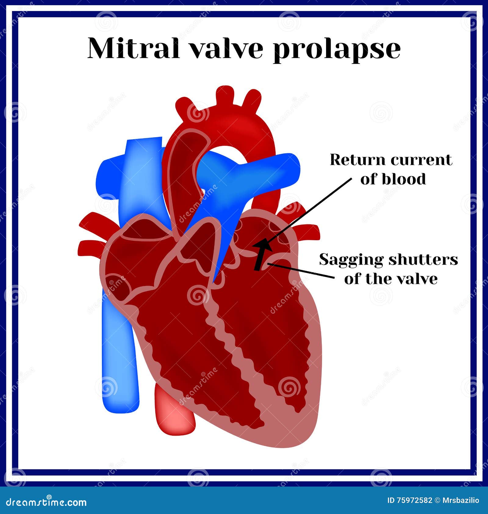 heart structure. mitral valve prolapse. cardiac pathology