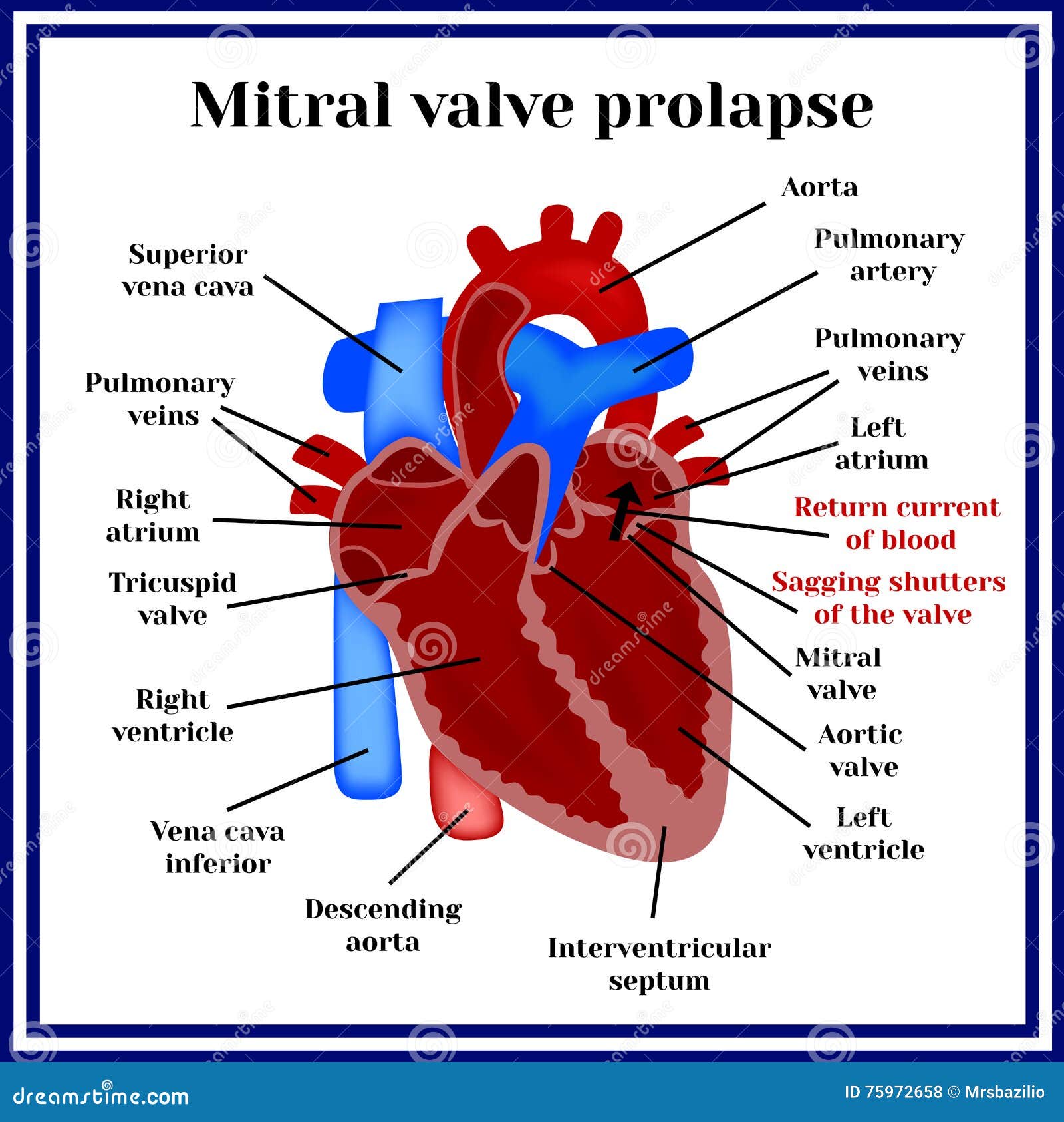 heart structure. mitral valve prolapse. cardiac pathology