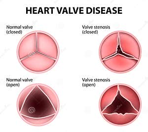 Heart Valve Disease Vector Illustration CartoonDealer 64582840