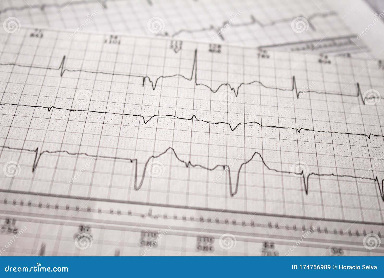 causes of extra heartbeat causes of extra heartbeat