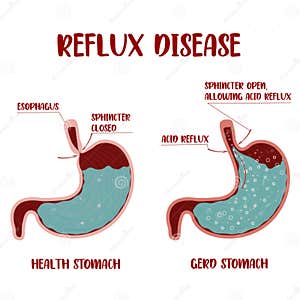 Symptoms Of Gastric Polyps Pedunculated And Flat based Polyp Antrum 