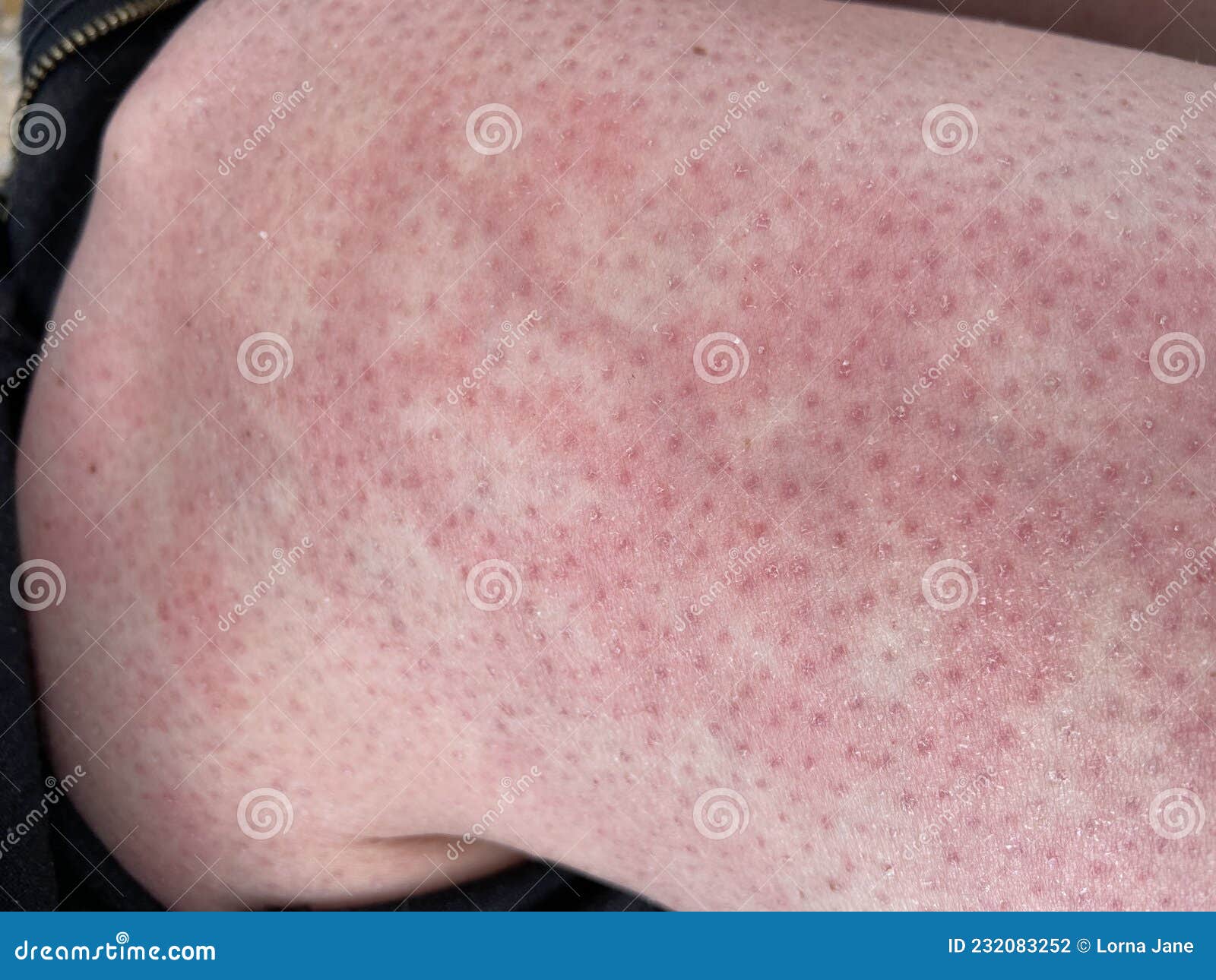 Heat Rash Hives Allergy Reaction Knee Close Up Reference Picture Of