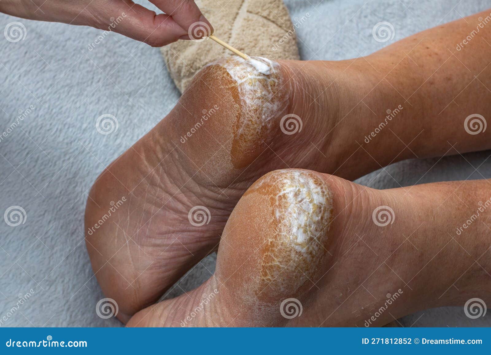 Heel with dry skin and cracks. Medical pedicure. An orthopedic doctor  applies a healing cream to the cracked heels of a sick man. The concept of  treating cracked heels. - Stock Image -