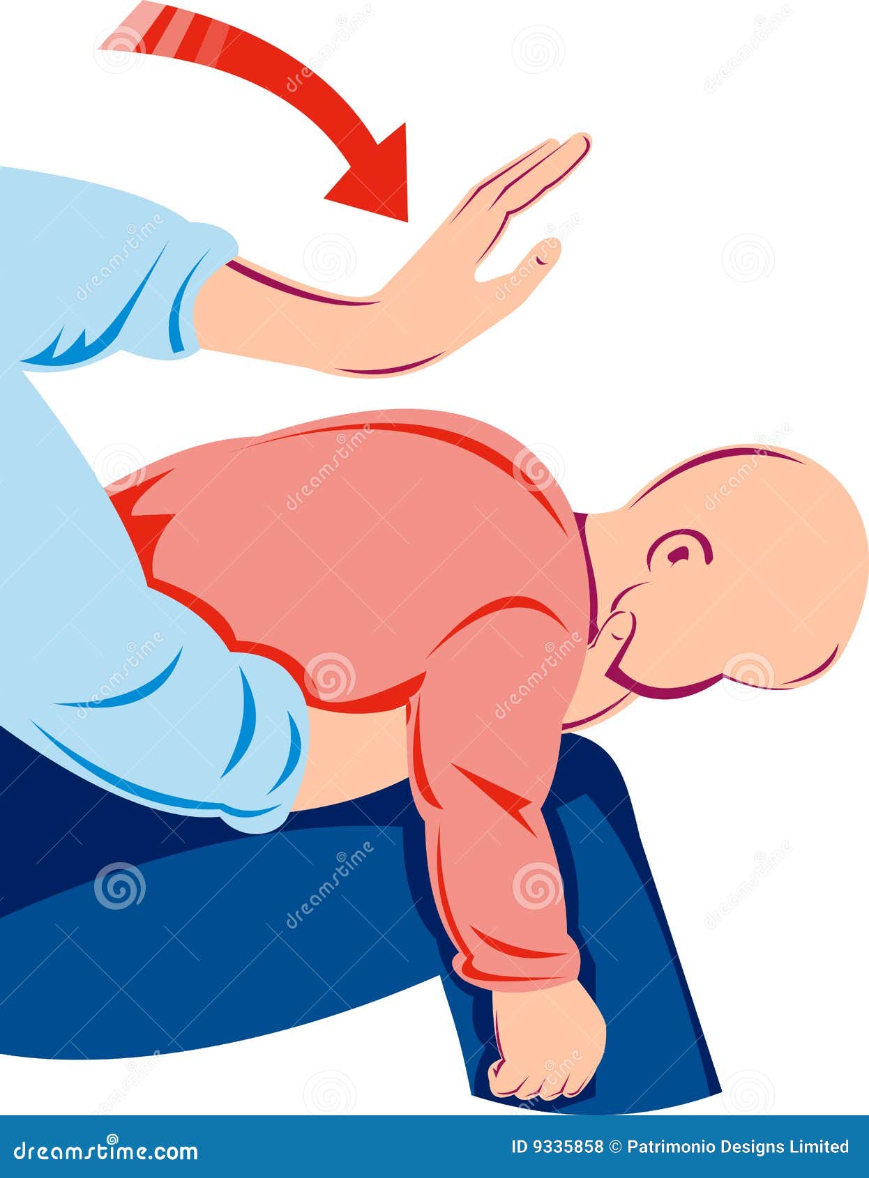 heimlich maneuver on infant