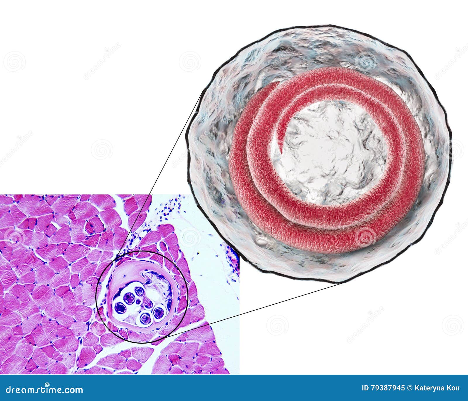 helminth trichinosis