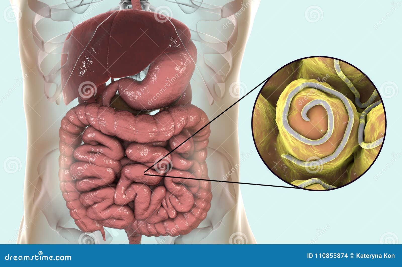 enterobiasis helminthiasis)