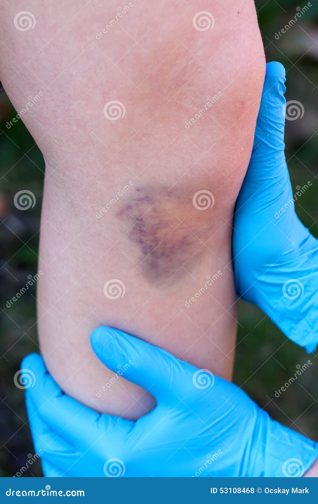 Hematoma stock photo. Image of medicine, closeup, emergency 53108468