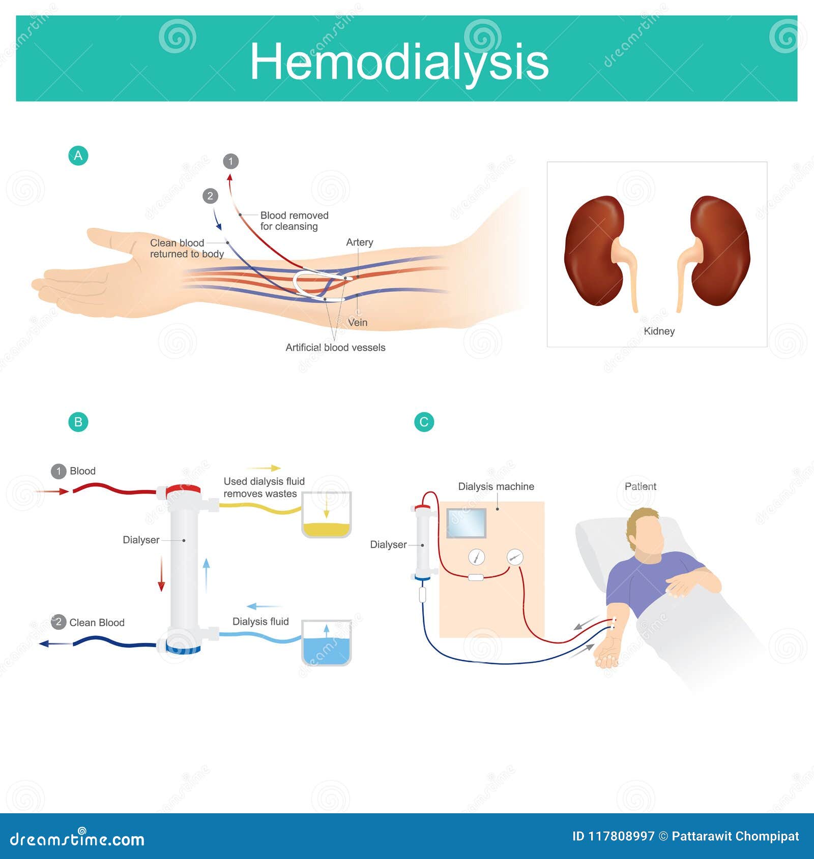 Hemodialysis Hemodialysis