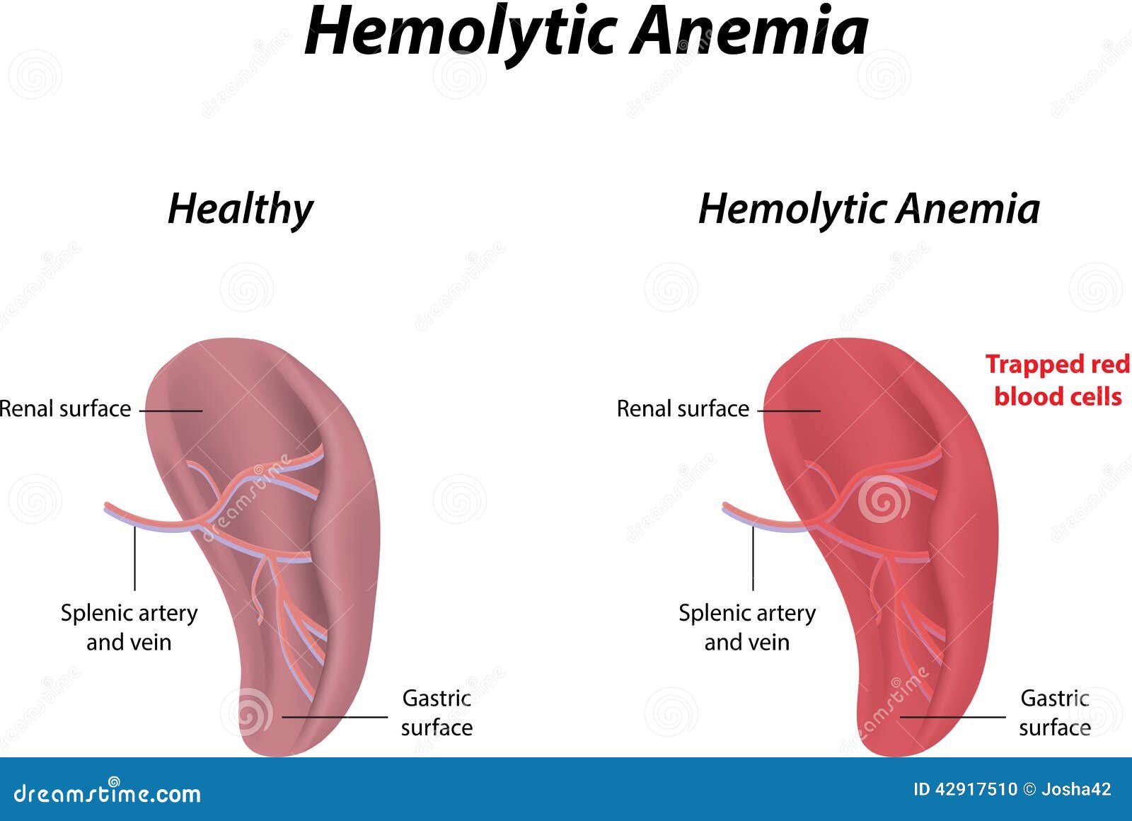 Hemolytic Anemia stock vector. Illustration of immune - 42917510