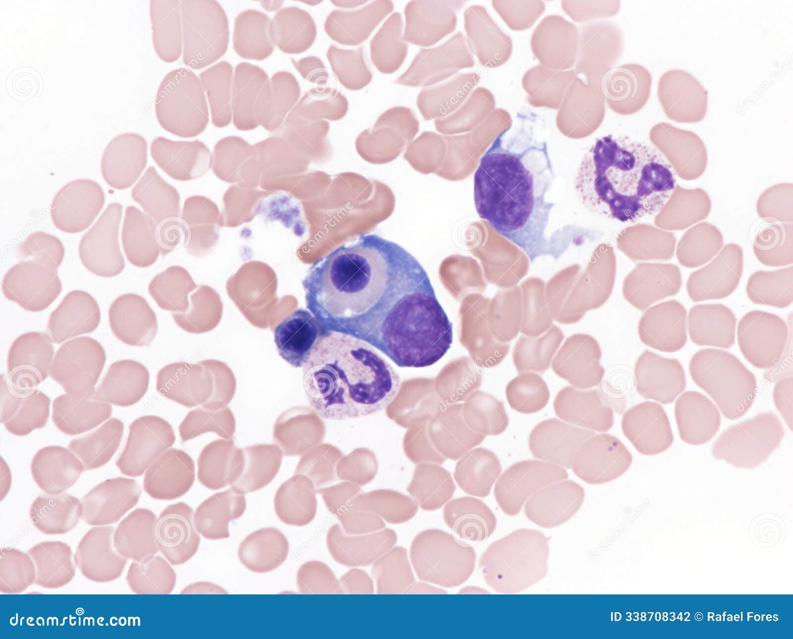 hemophagocytosis by plasma cell in a case of multiple myeloma.