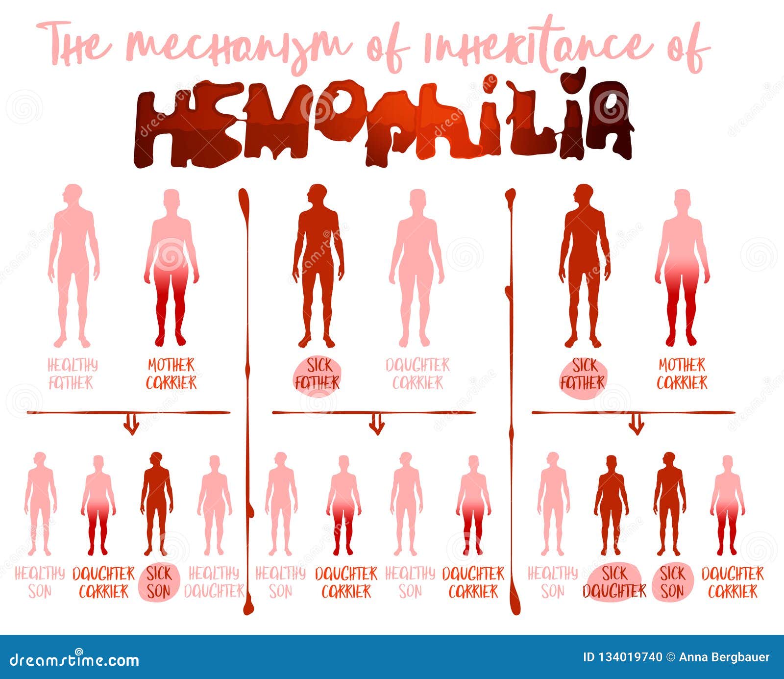 Гематофилия. Инфографика гемофилия. Группы крови инфографика. Кровь инфографика. Кровь в человеке инфографика.