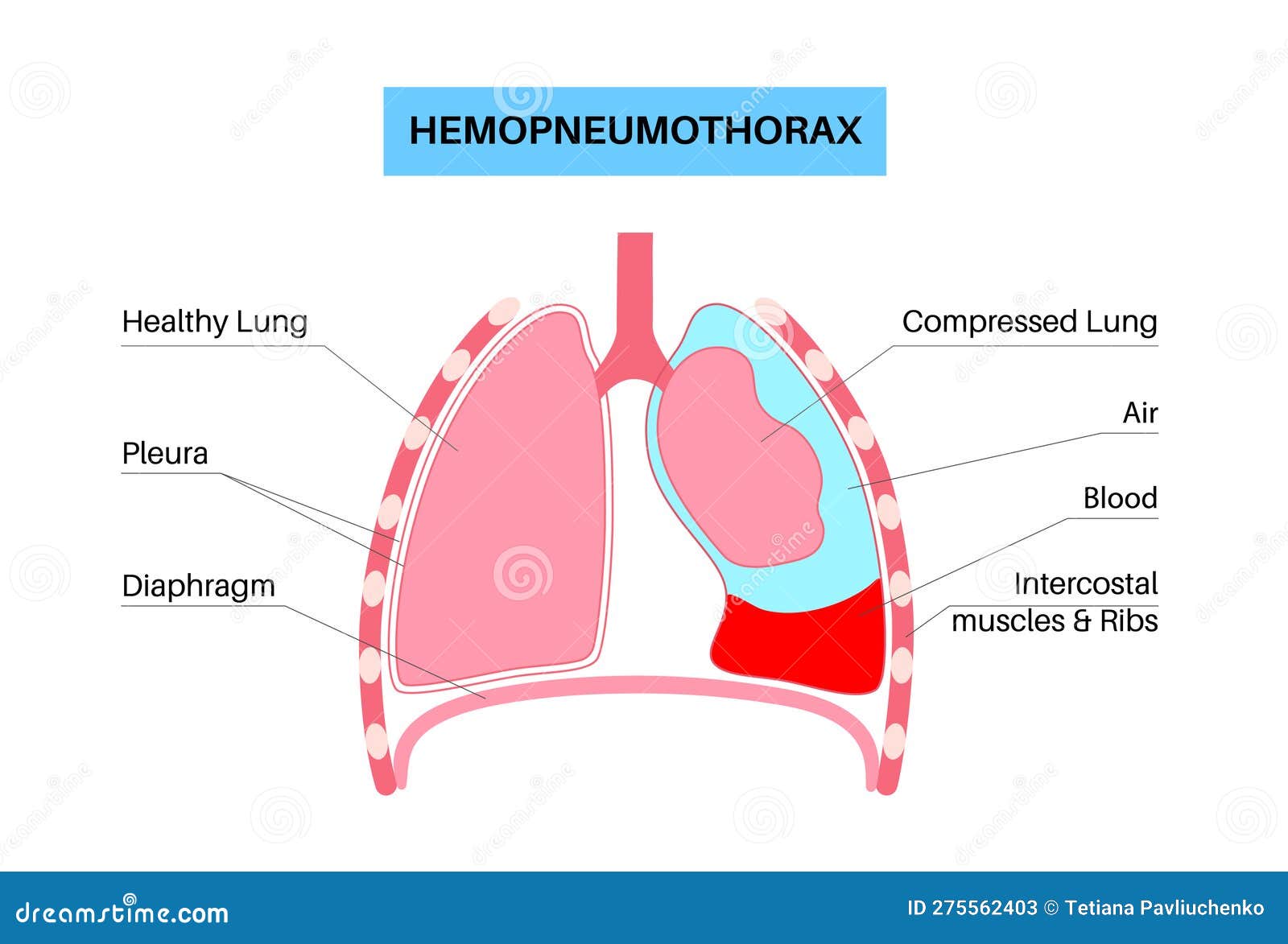 Hemopneumothorax Medical Poster Stock Vector - Illustration of ...