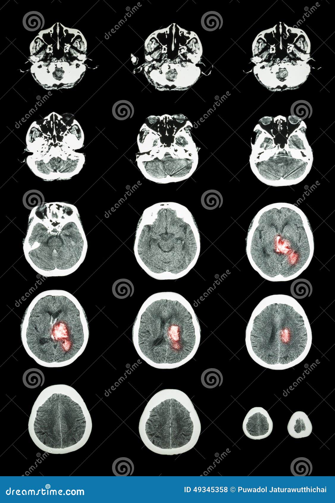 hemorrhagic stroke . ct scan (computed tomography) of brain ( c
