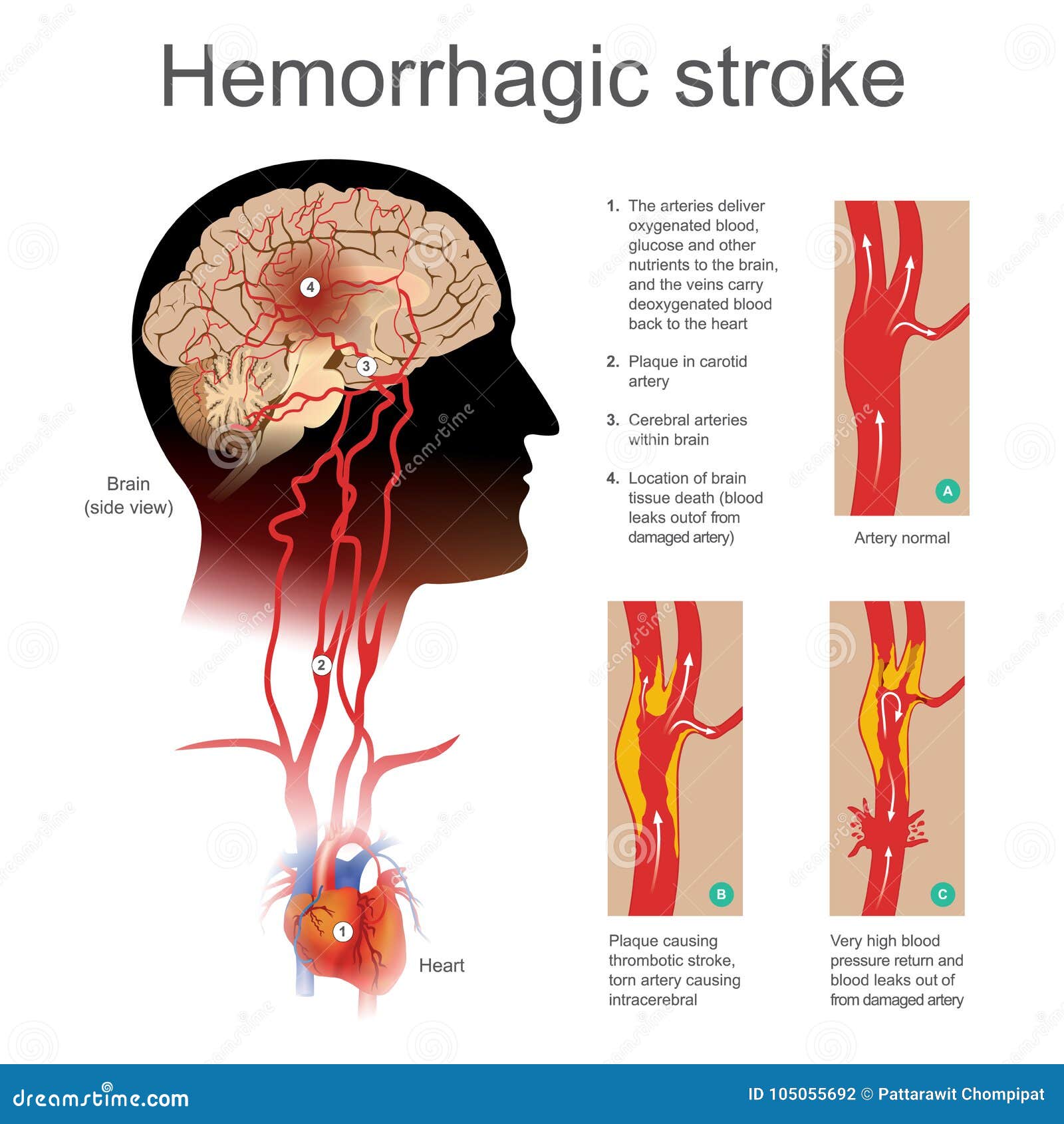 hemorrhagic stroke. plaque causing thrombotic stroke torn artery causing intra cerebral.