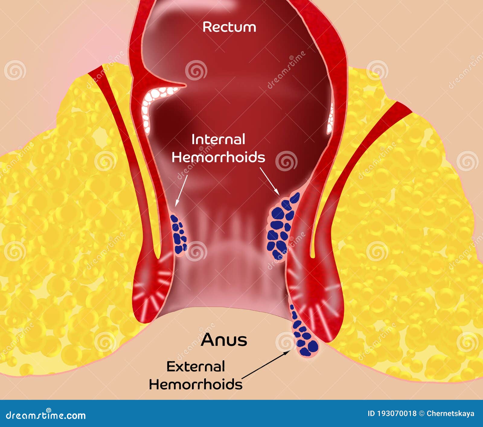 Constipation Haemorrhoids And Abdominal Pain Stock Photography