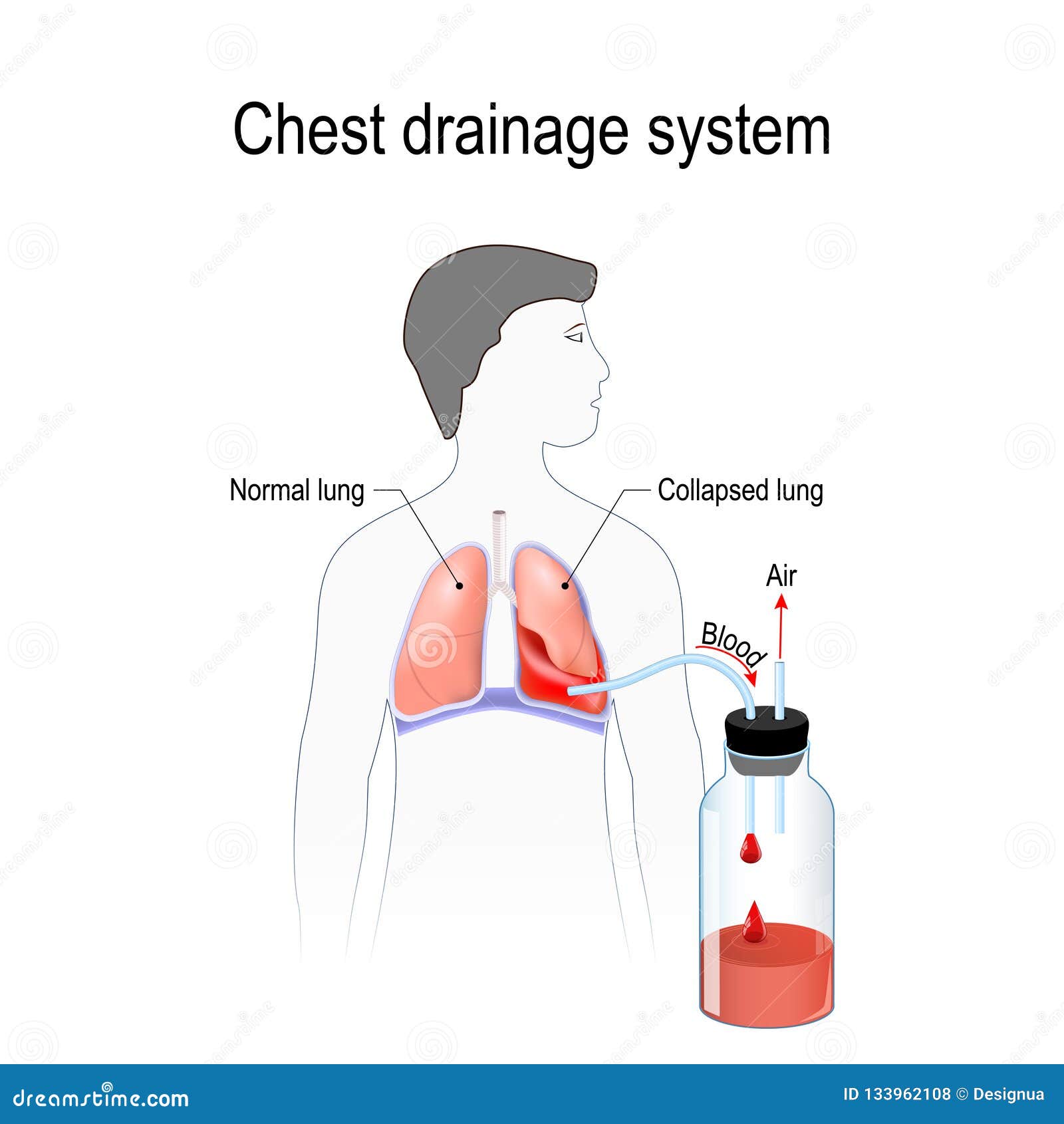 chest tube pneumothorax