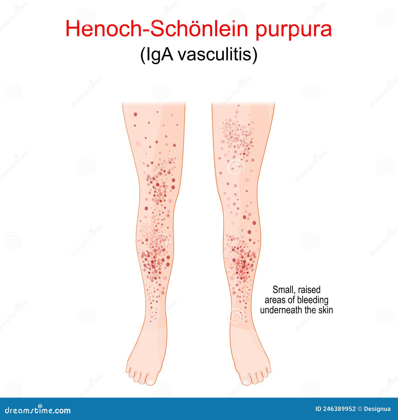 henoch-schÃÂ¶nlein purpura. spotty rash on the humans legs