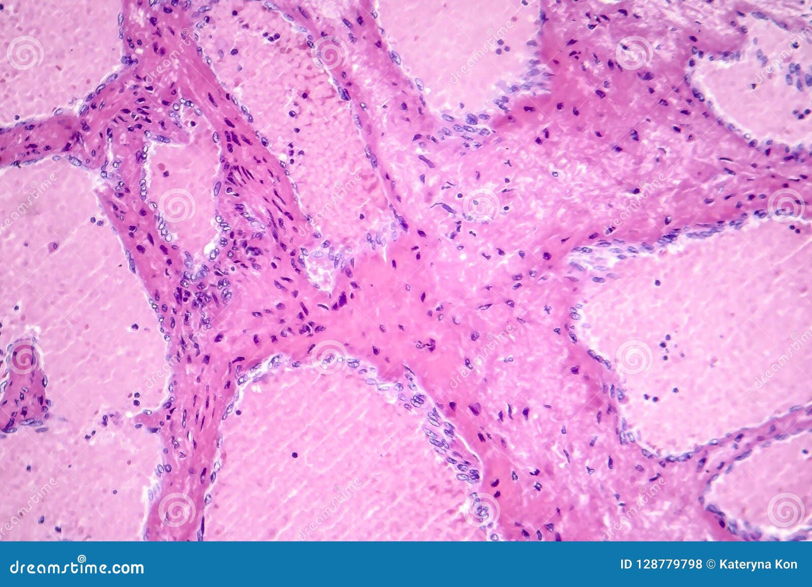 hepatic cavernous hemangioma