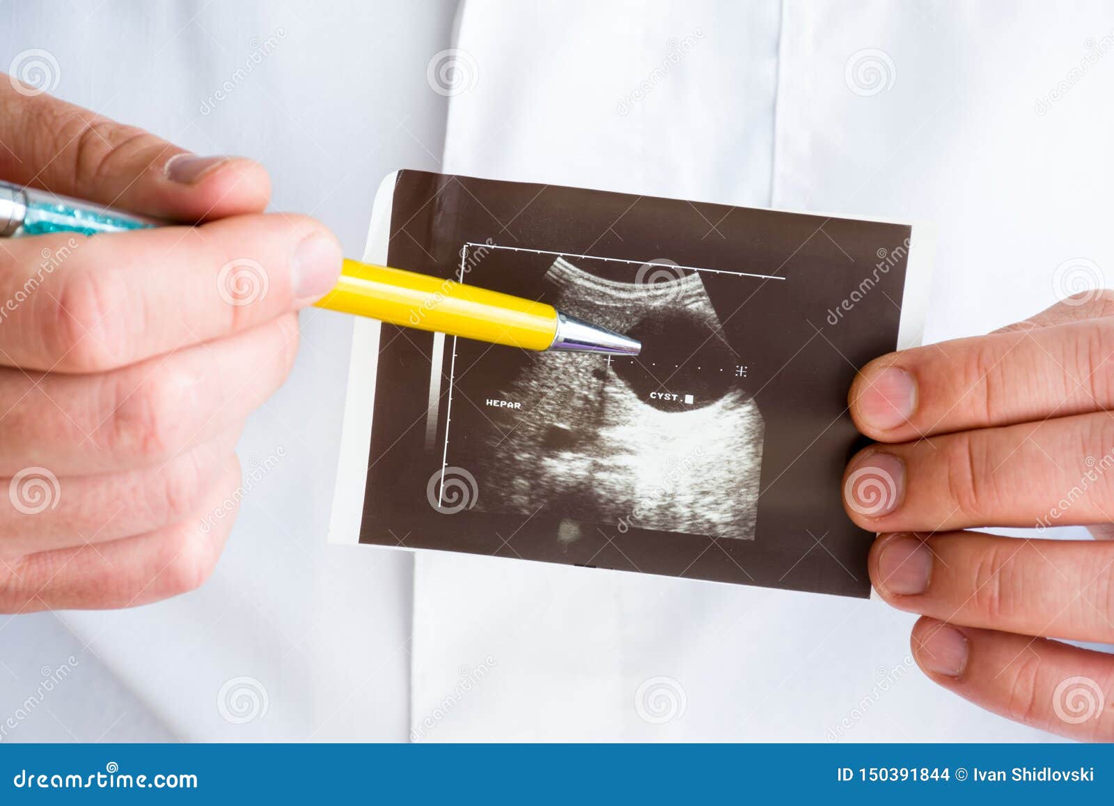 hepatic or liver cyst on ultrasound image concept photo. doctor indicating by pen on printed picture ultrasound pathology - hepati