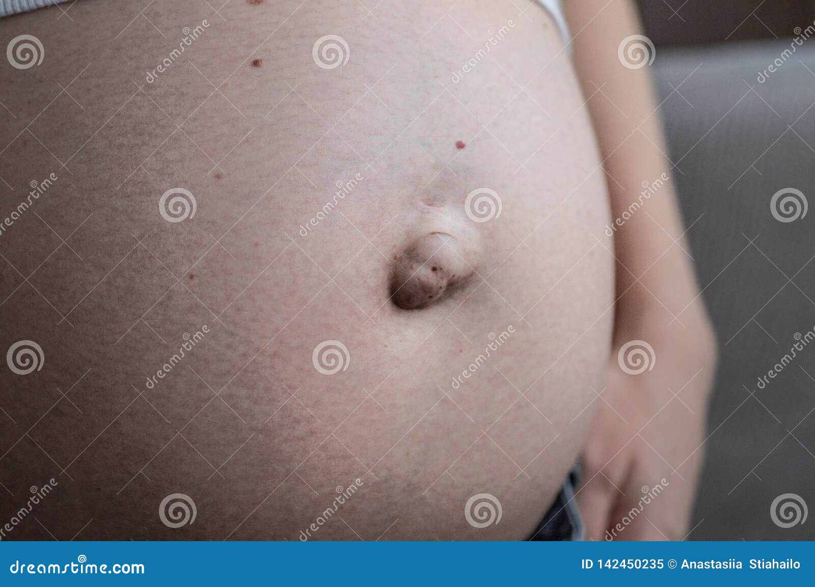 Hernia Umbilical En Una Mujer Embarazada Primer Imagen de archivo