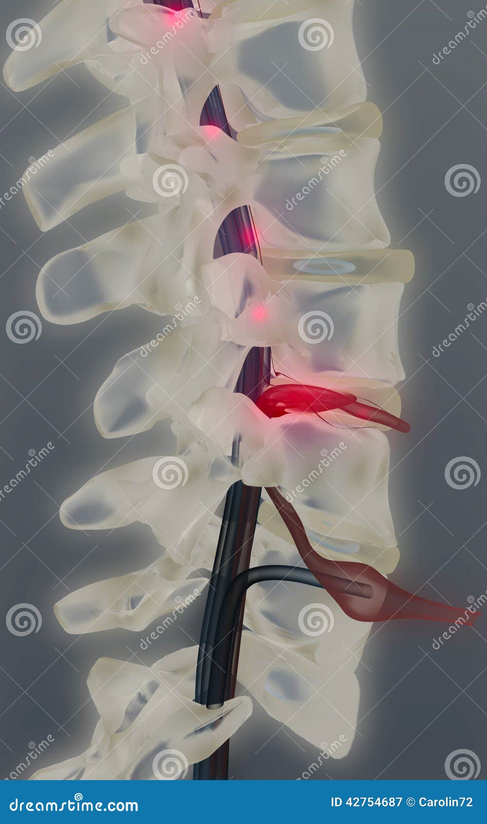 herniated vertebral disk