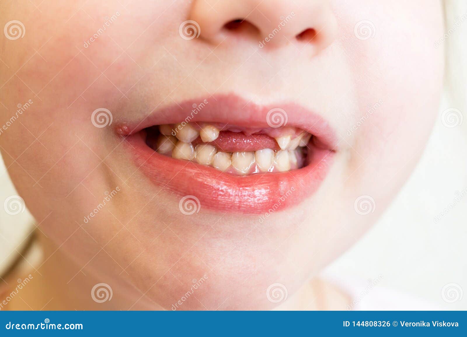 Herpes On The Baby S Lips The Baby Girl Shows A Smile With Missing Front Teeth Treatment Ointment Selective Focus Photo Stock Image Du Plainte Ampoule Herpes On The Baby S Lips The Baby Girl Shows A Smile With Missing Front Teeth Treatment Ointment Selective Focus Photo Stock Image Du Plainte Ampoule