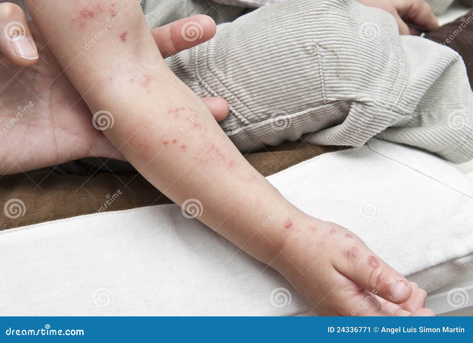 herpes in a child arm.