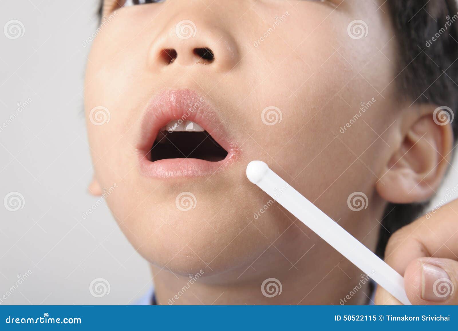 Herpes on kid mouth stock image. Image of sore, lips 50522115