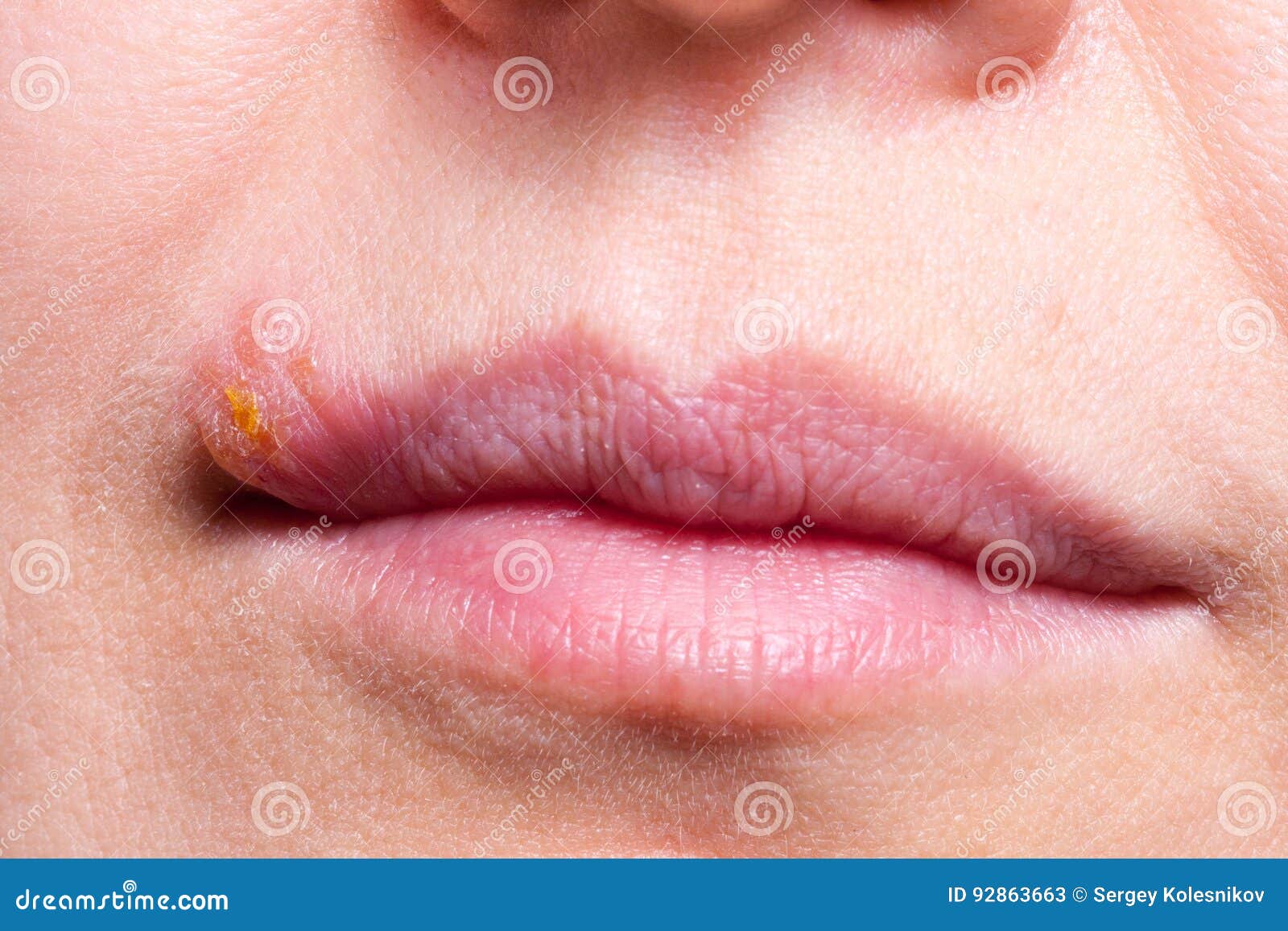 Herpes on the Lip Close Up Macro Stock Image Image of adult, dermatology 92863663