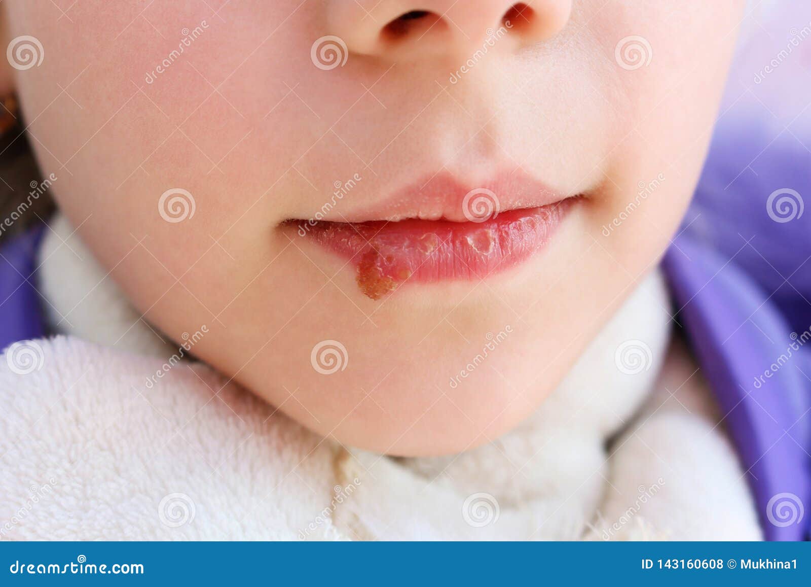 Herpes on Lips of Child. Treatment Ointment Stock Photo Image of