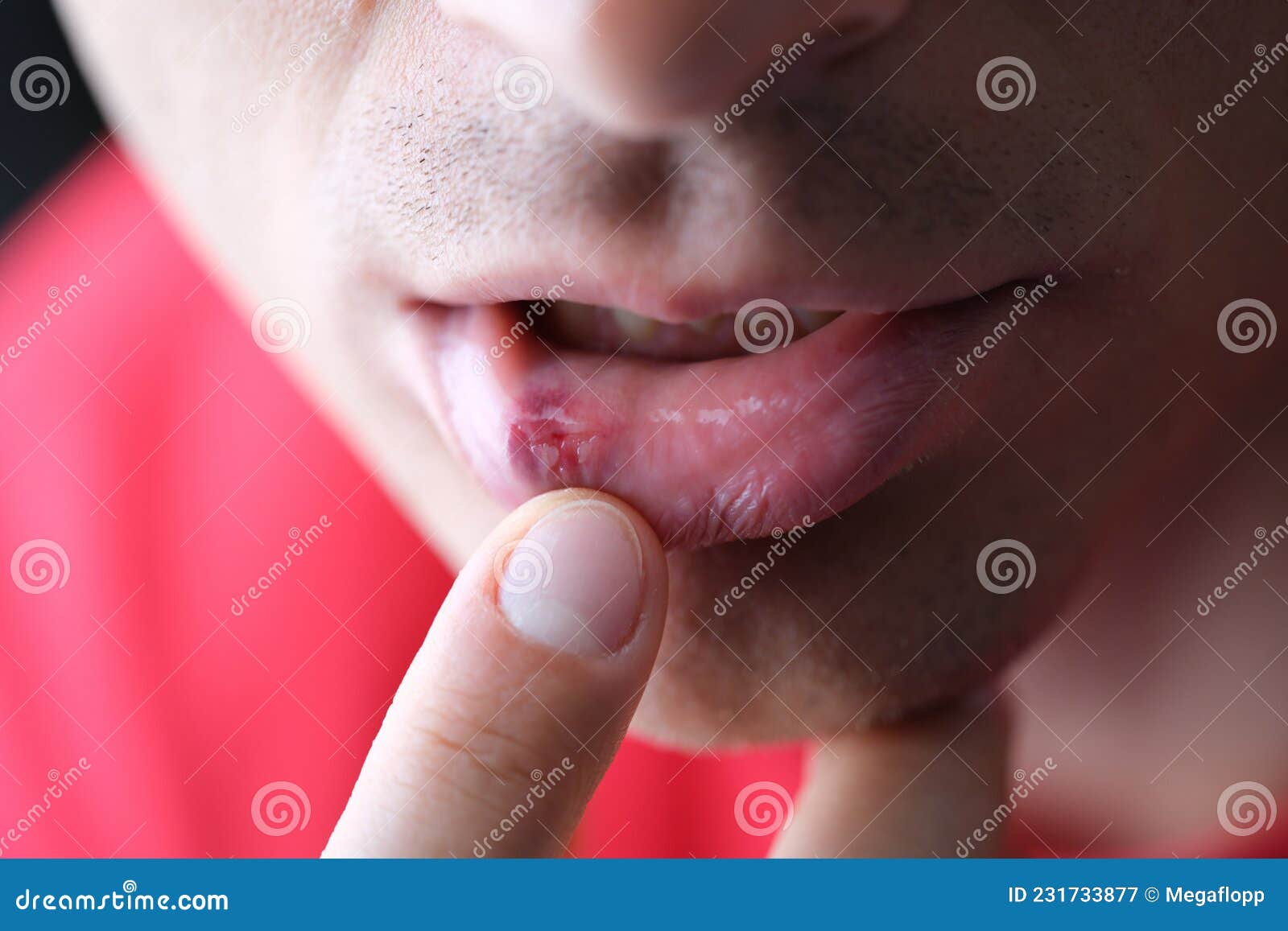 Herpes 2024 inner lip