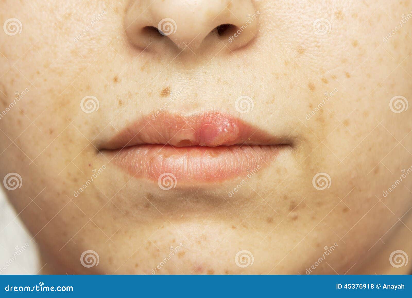 Herpes Oral Cold Sore Blisters On The Lips Herpes Simplex Stock Photo
