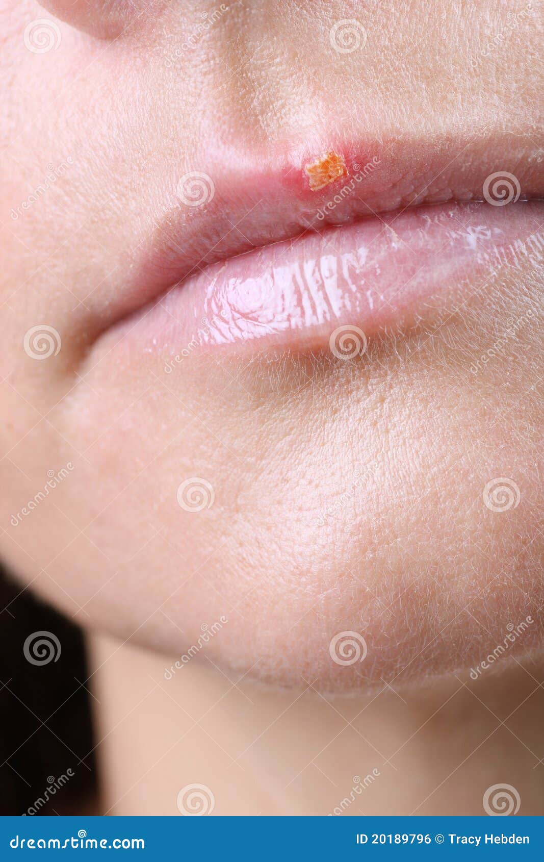 Herpes Simplex Infections | Herpes.org