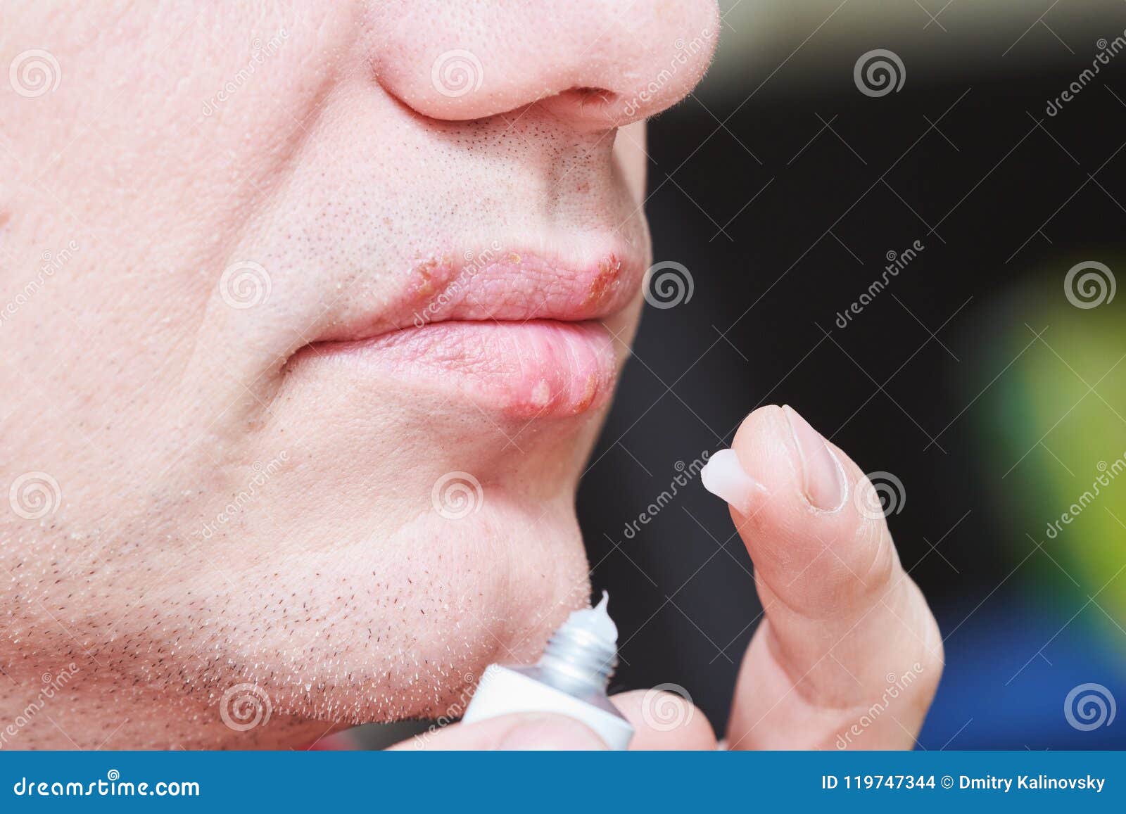 herpes zoster on lips treatment