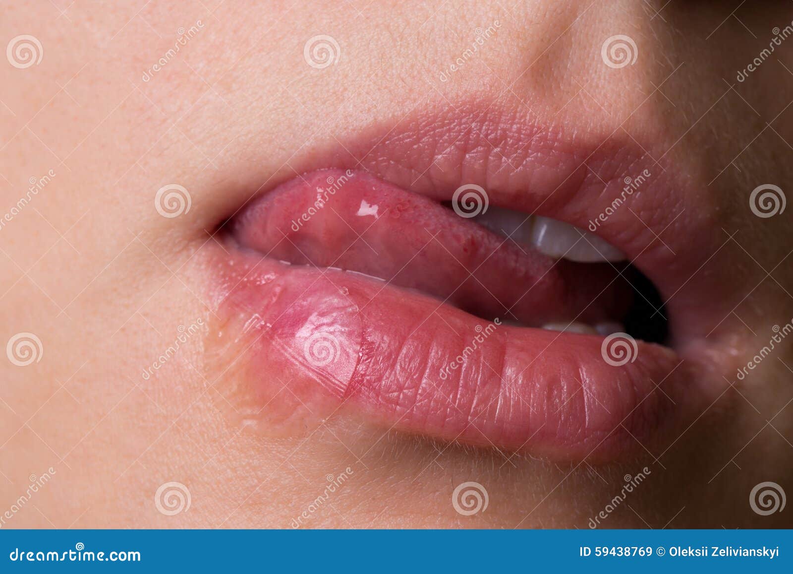 How to cure herpes on lip