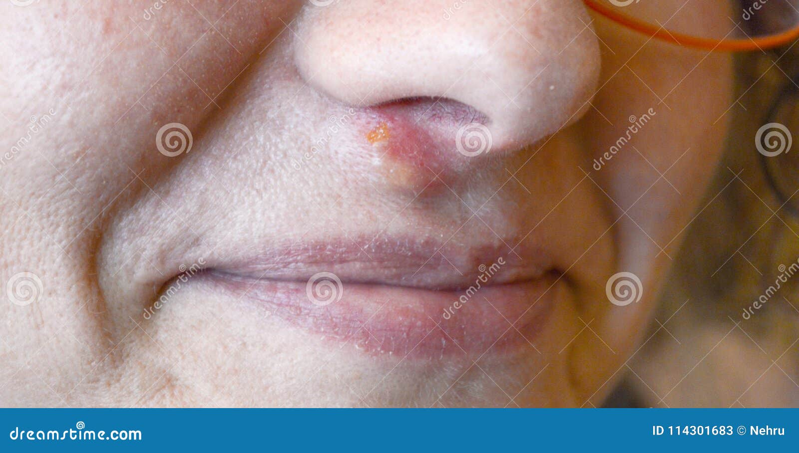 herpes under näsan herpes under näsan