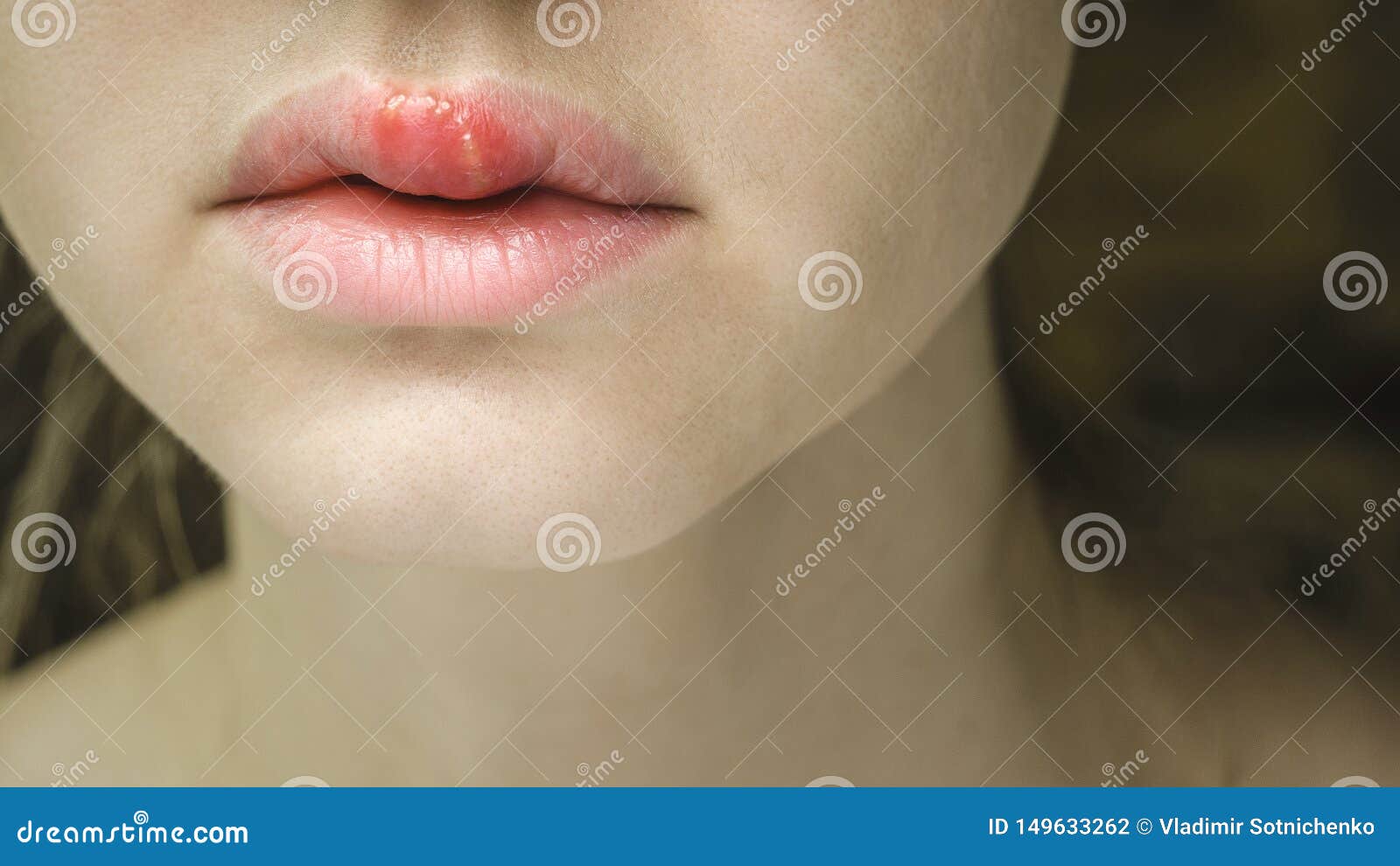 herpes simplex virus on the upper lip of a young beautiful woman.