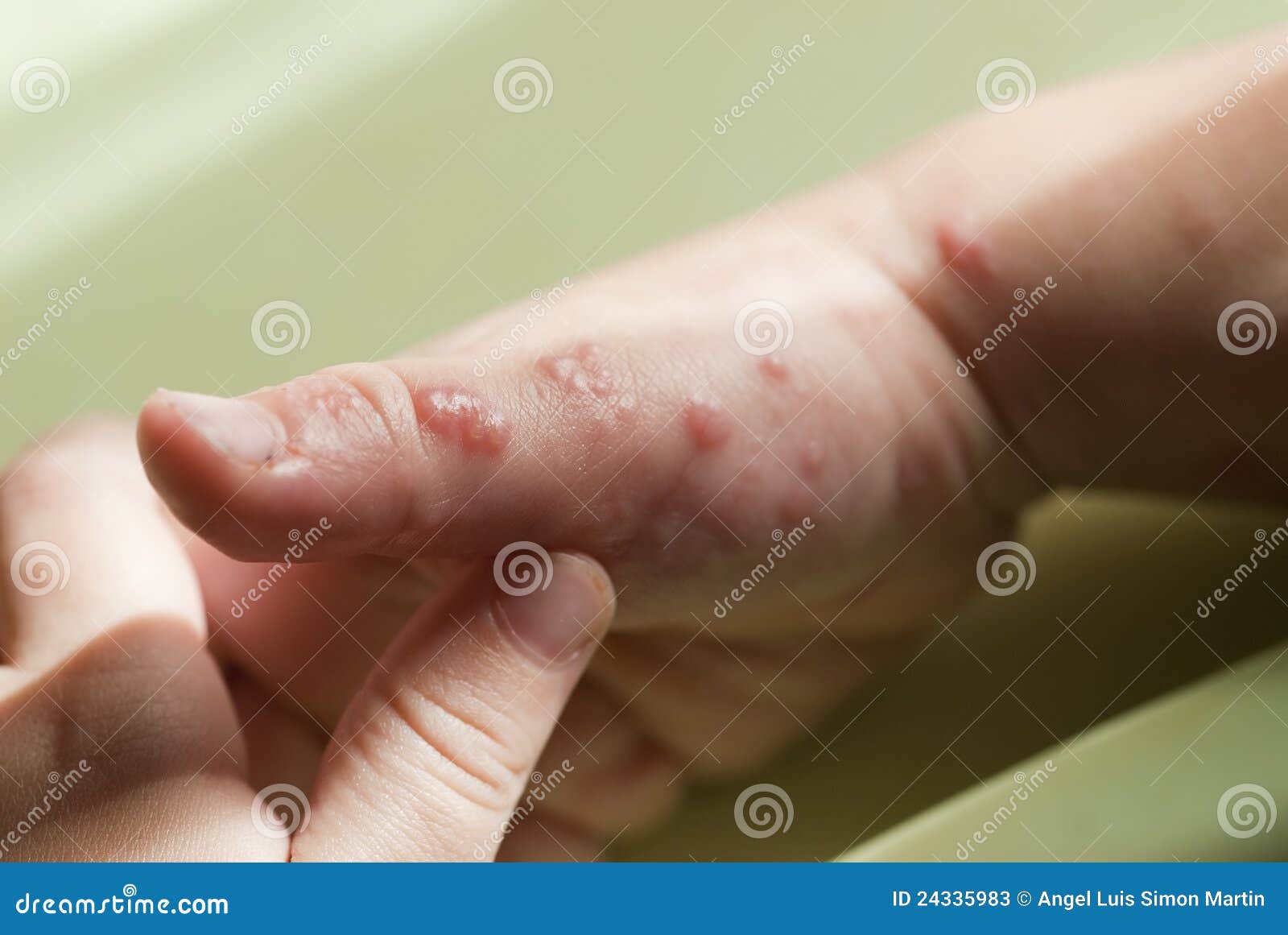 herpes zoster in a child hand.
