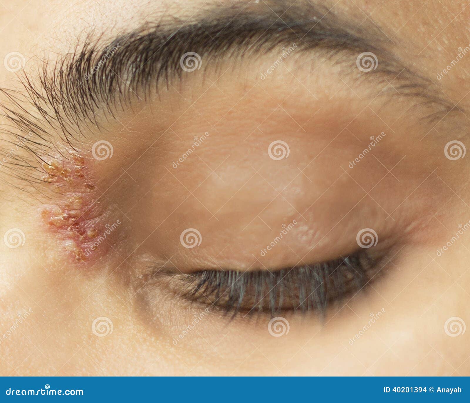 herpetic eye disease - herpes zoster ophthalmicus