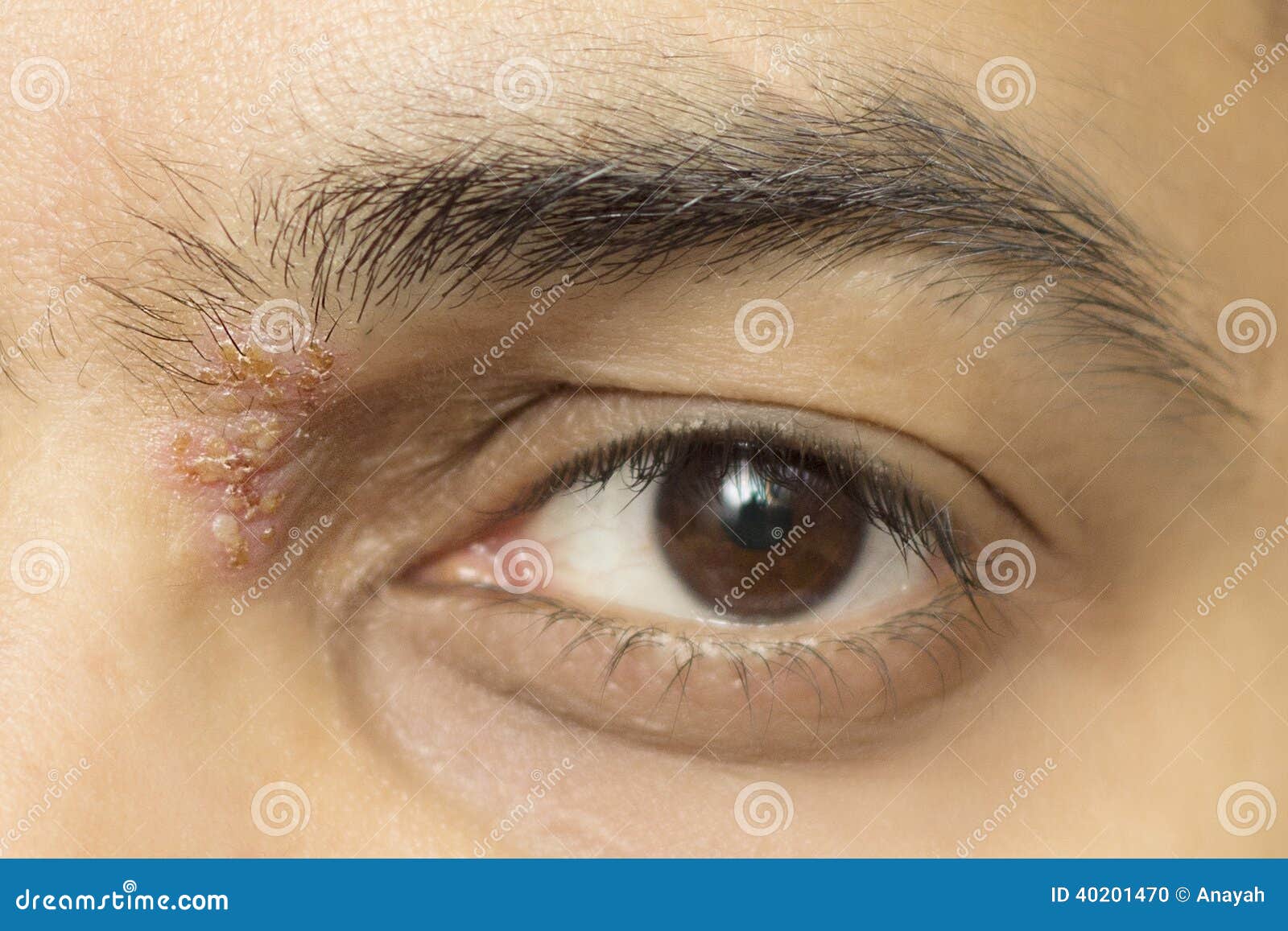 herpetic eye disease - herpes zoster ophthalmicus