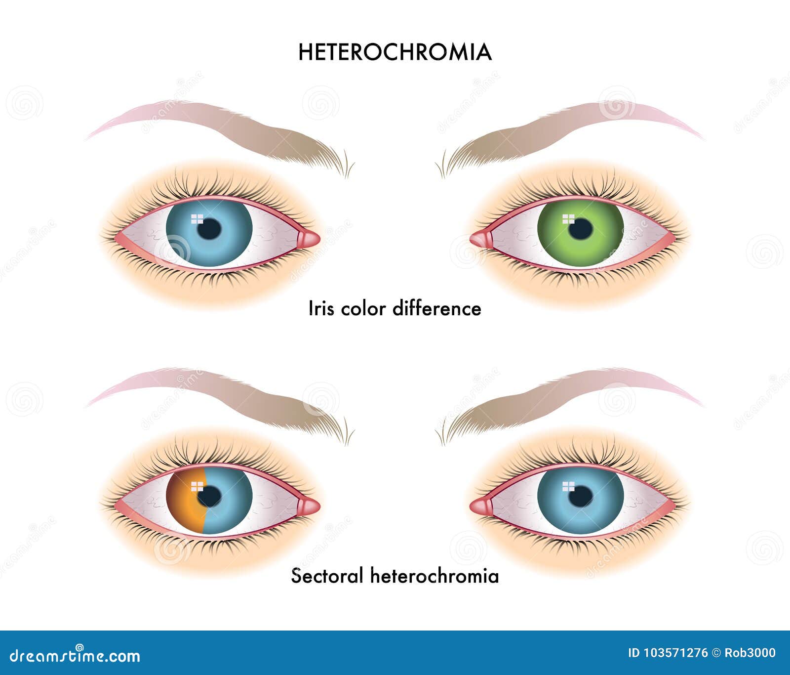 Heterocromia (ochii de culori diferite) | ROmedic