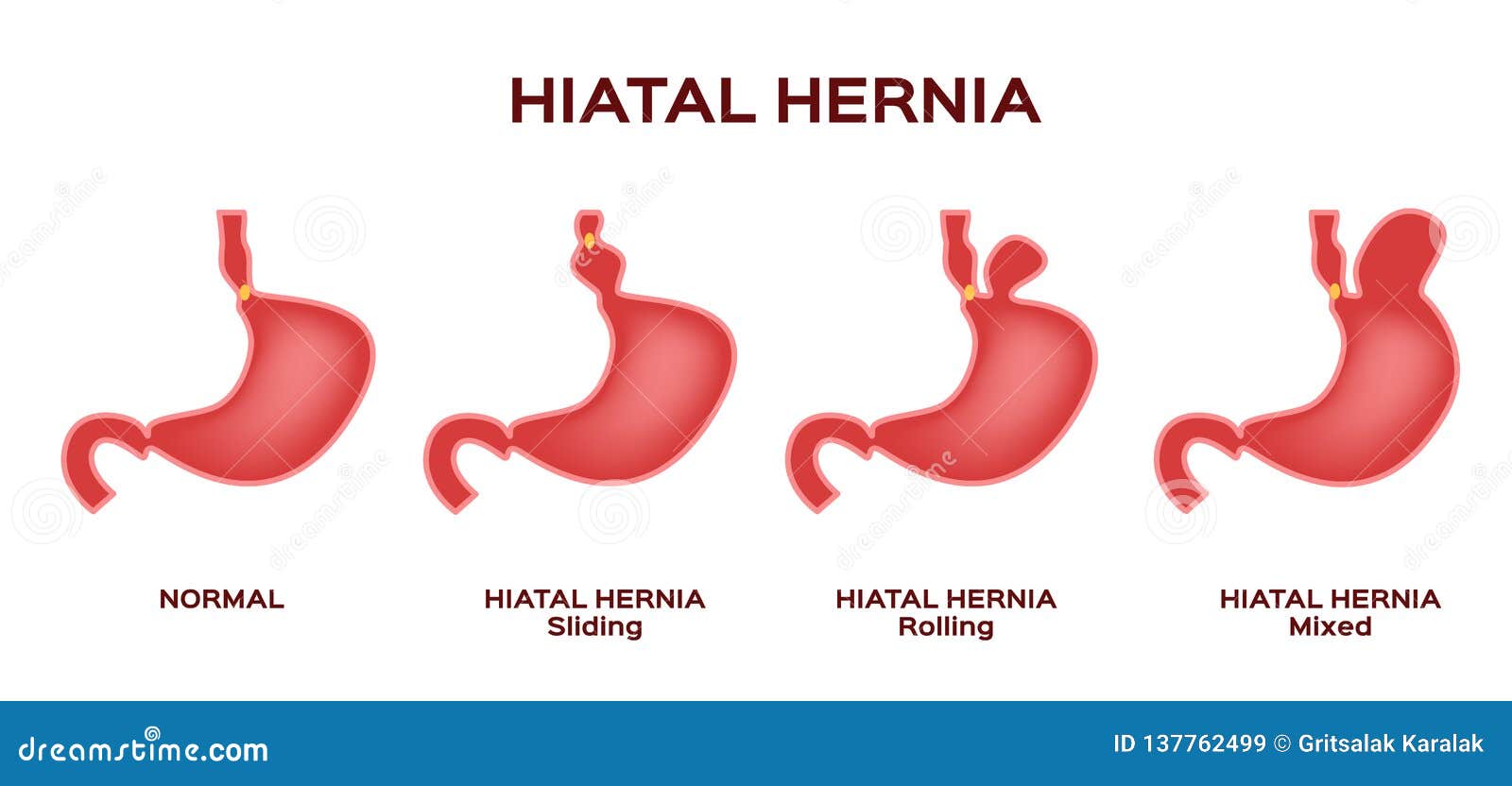 Hiatal hernia / stomach stock vector. Illustration of junction - 137762499