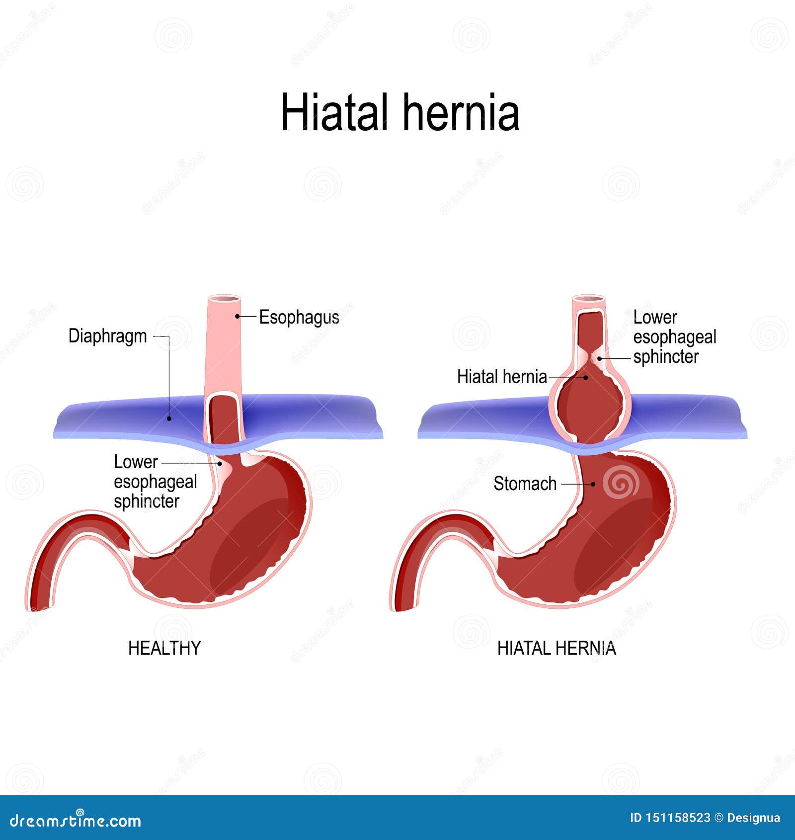 Hernia Cartoons, Illustrations & Vector Stock Images - 568 Pictures to