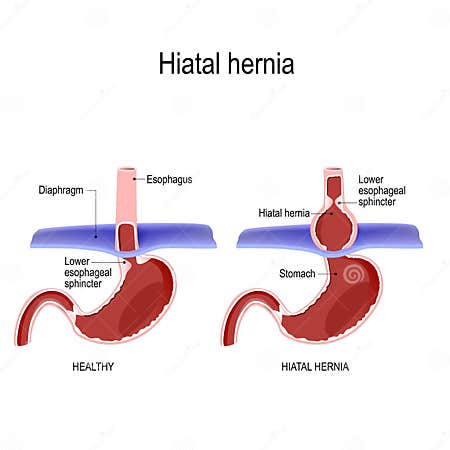 Hiatal Hernia. Vector Diagram of Normal Anatomy and Sliding Hiatal ...