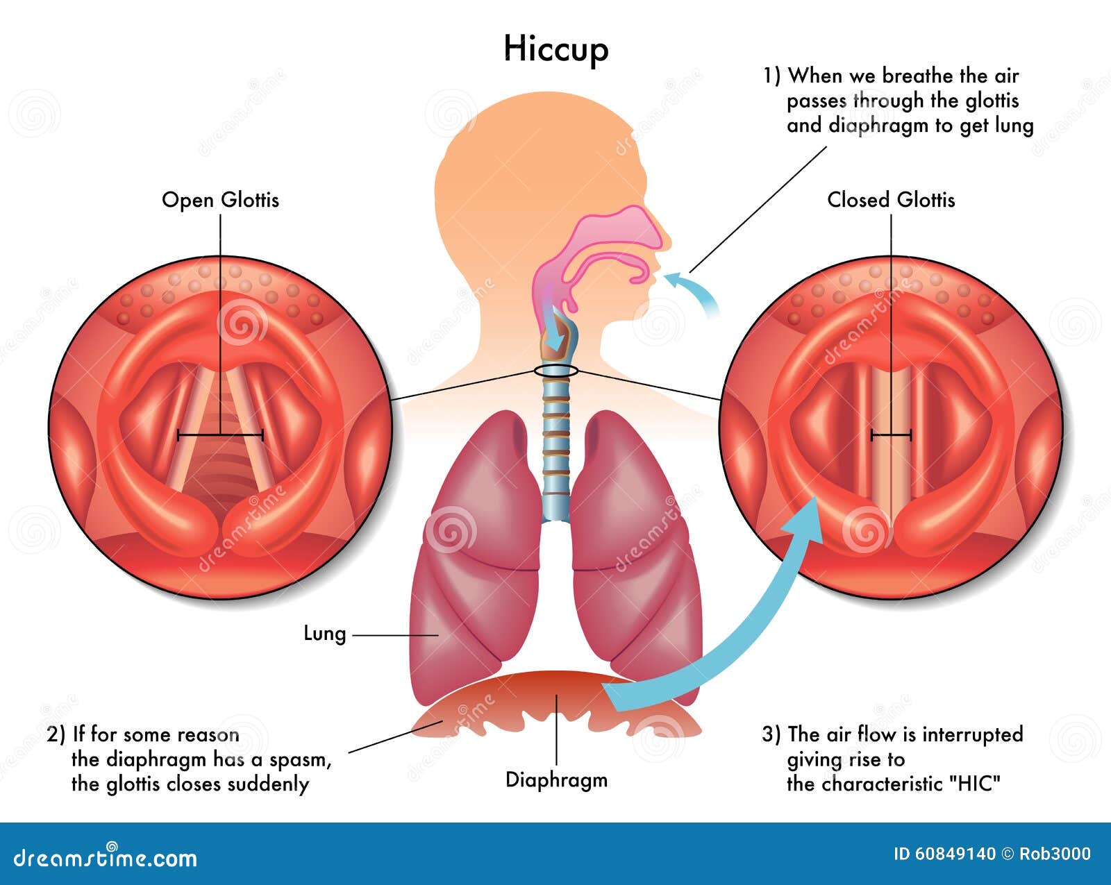 Hiccup Stock Photo Image 60849140