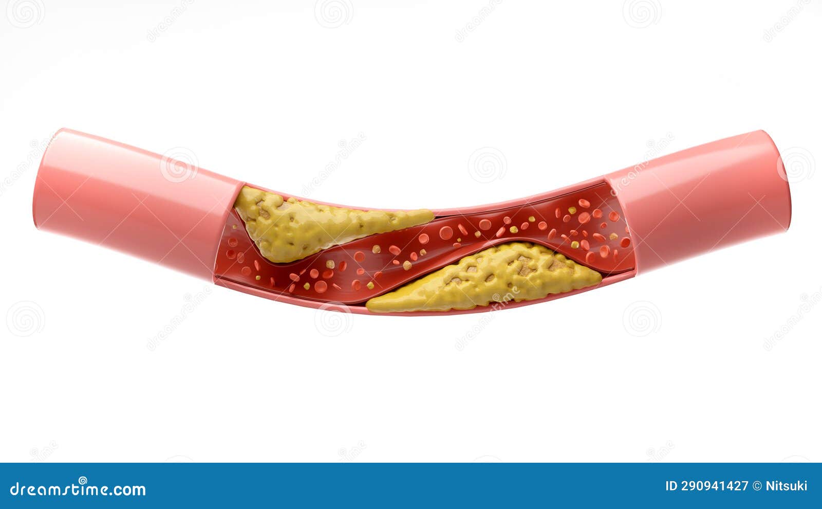 High Cholesterol Level And Atherosclerosis Health Concept Vector webmd-cholesterol-management-guide-living-with-high-cholesterol